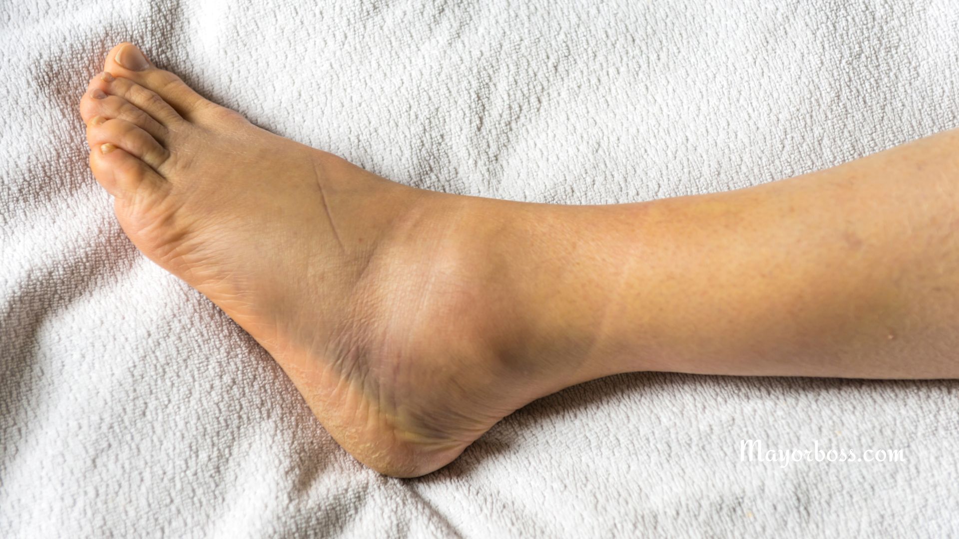 Why Your Legs May Be Swollen