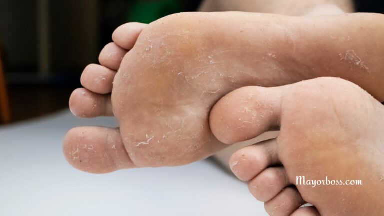 Home Remedies for Athlete's Foot