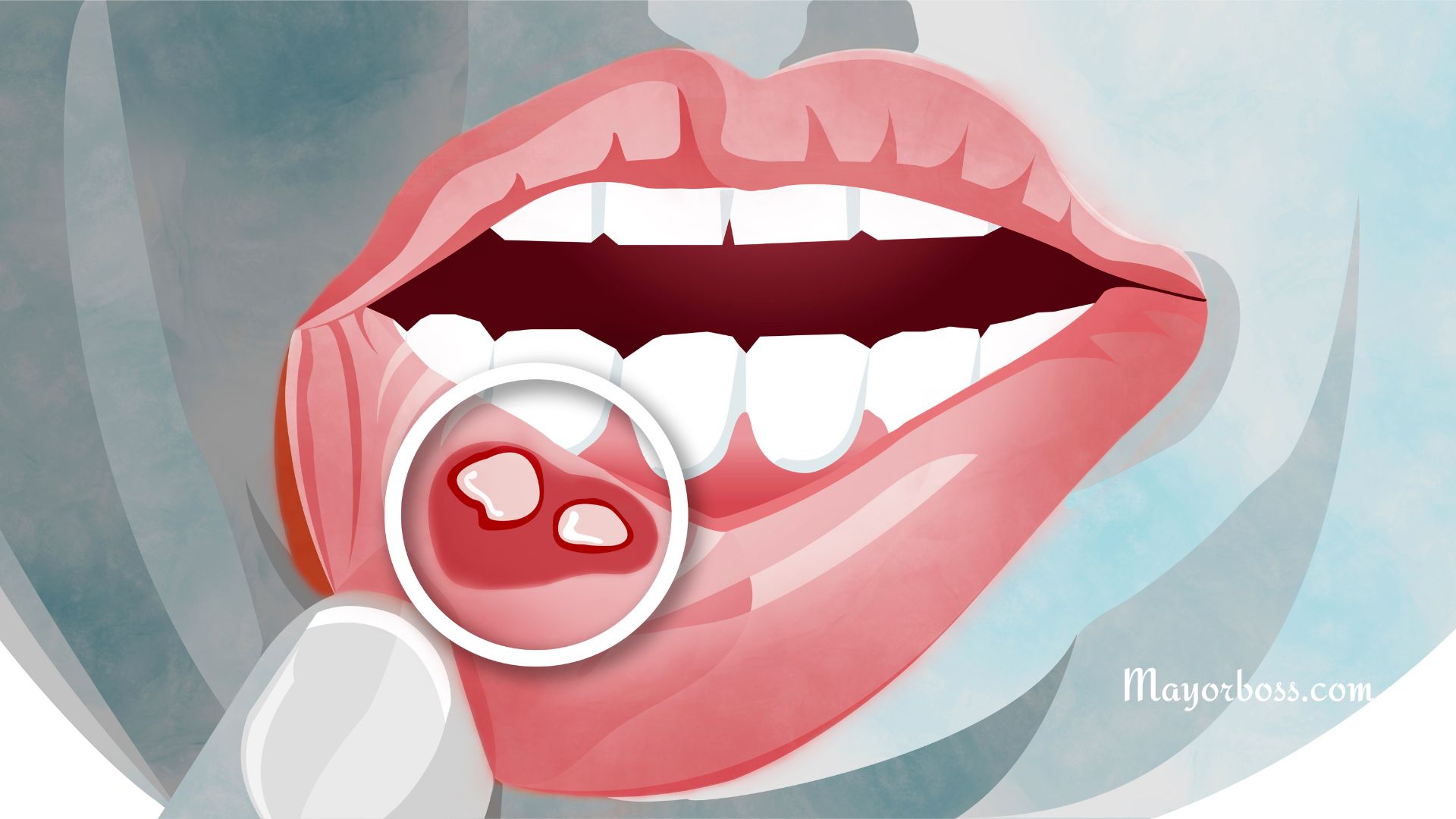 Home Remedies for Canker Sores