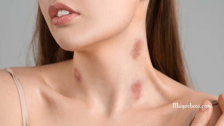 How to Get Rid of a Hickey