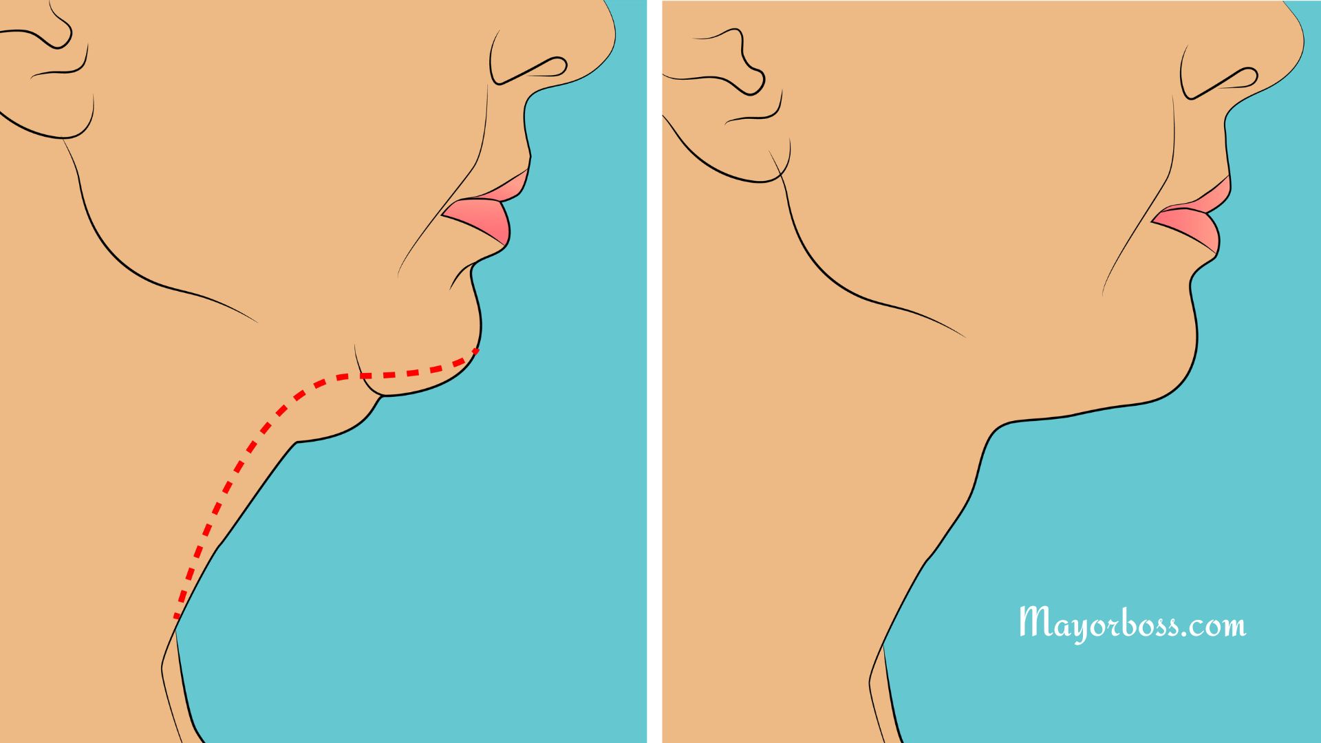 How to Reduce Double Chin Fat