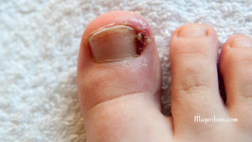 Remedies for Ingrown Toenails