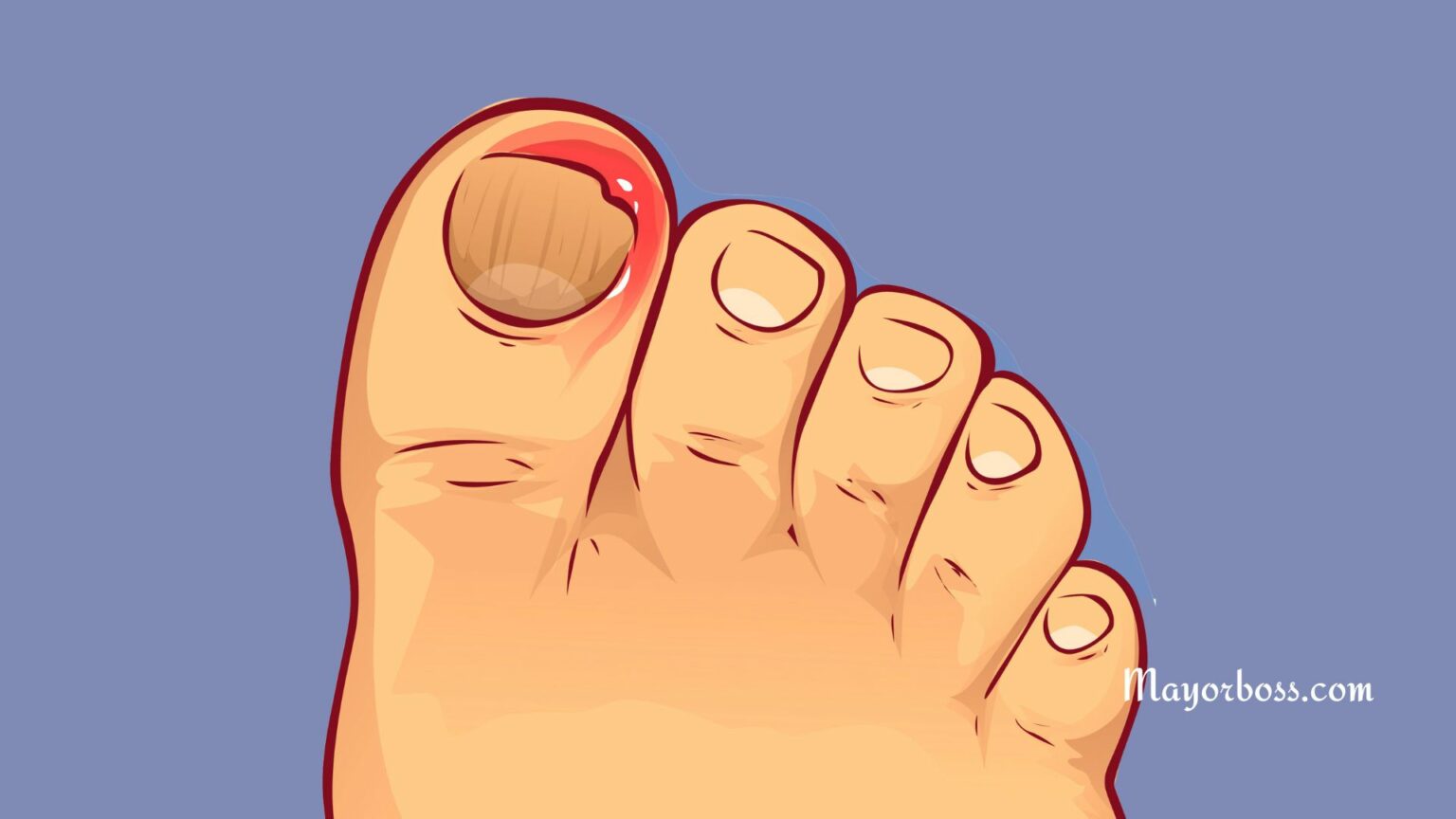 6 Remedies for Ingrown Toenails