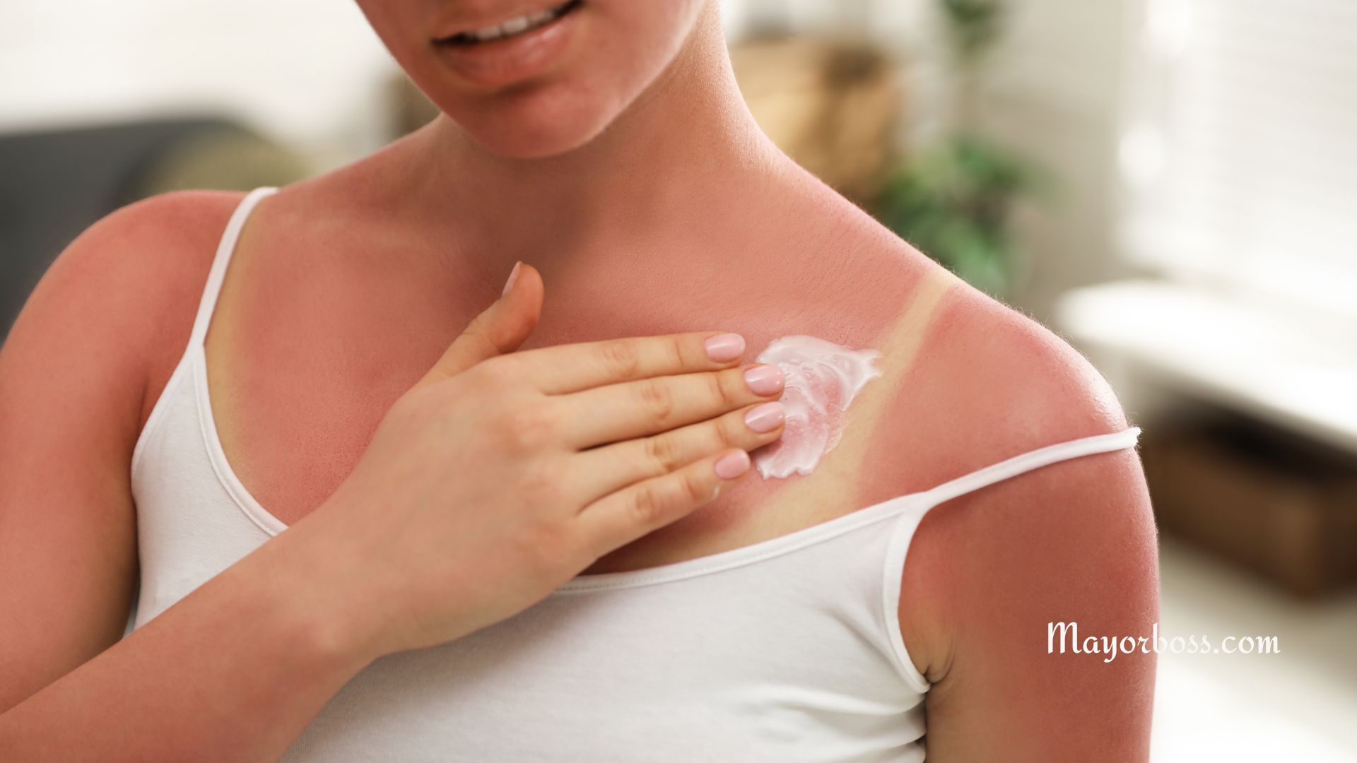 How to Get Rid of Sunburn Fast