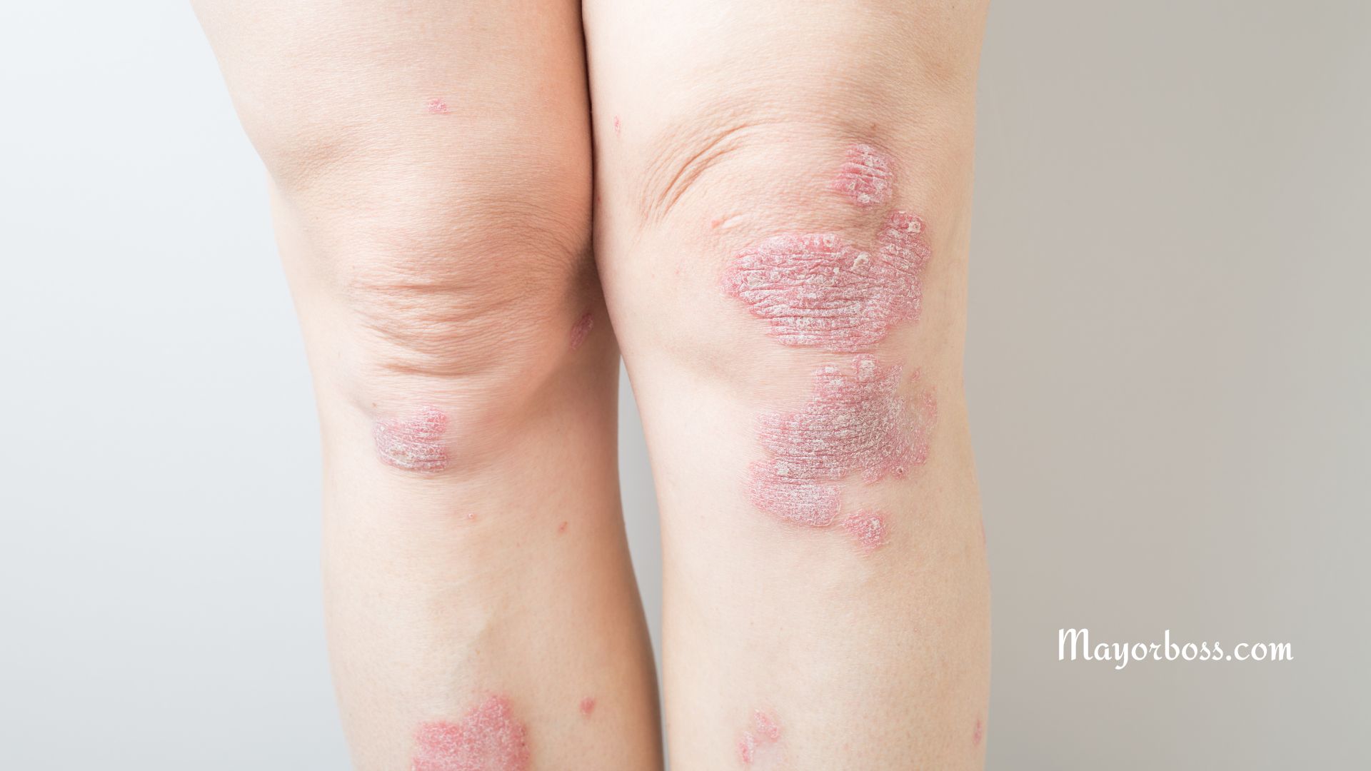 Psoriasis: Causes, Symptoms, and Treatment