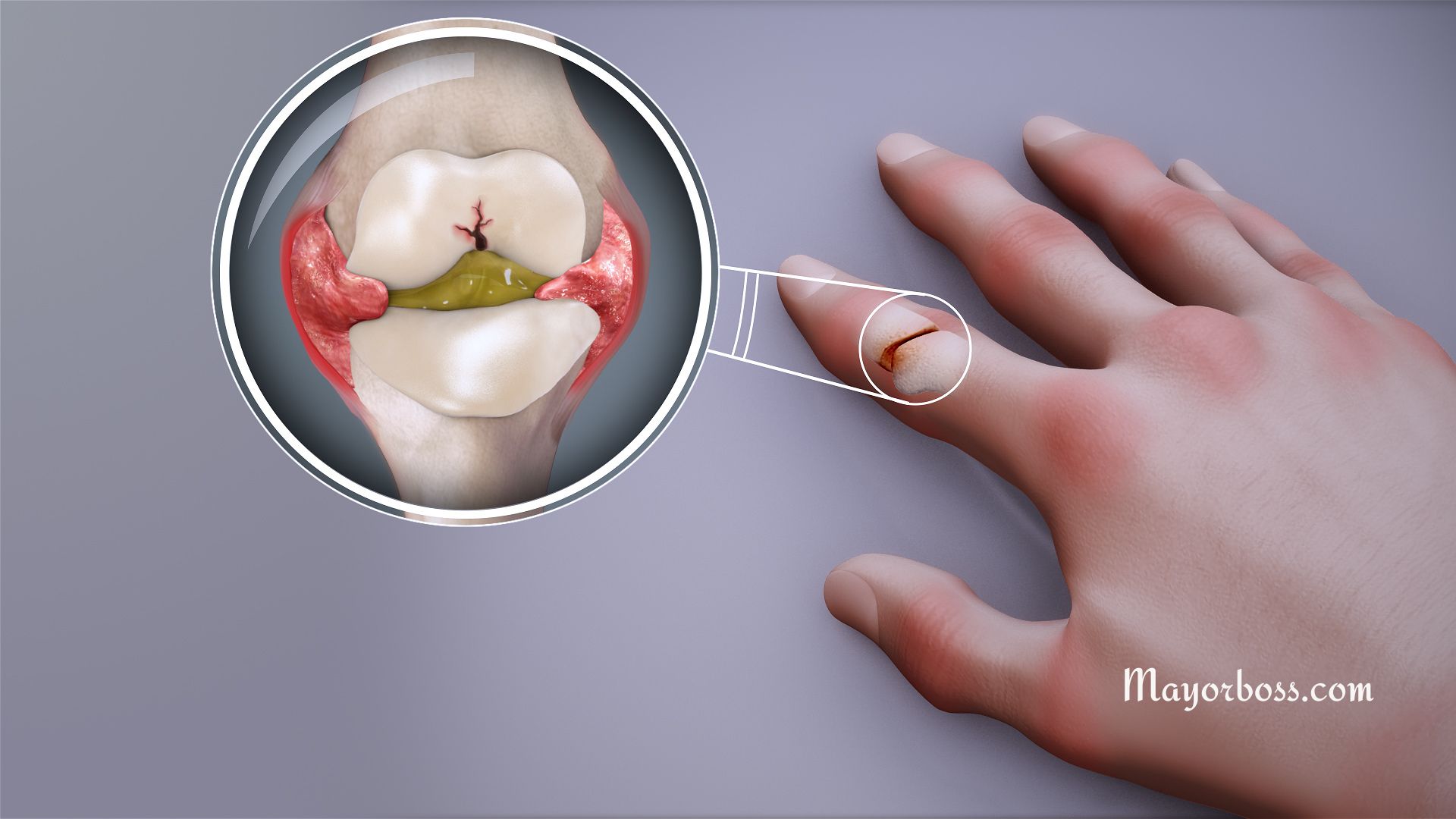 Here’s How to Recognise the Signs of Arthritis