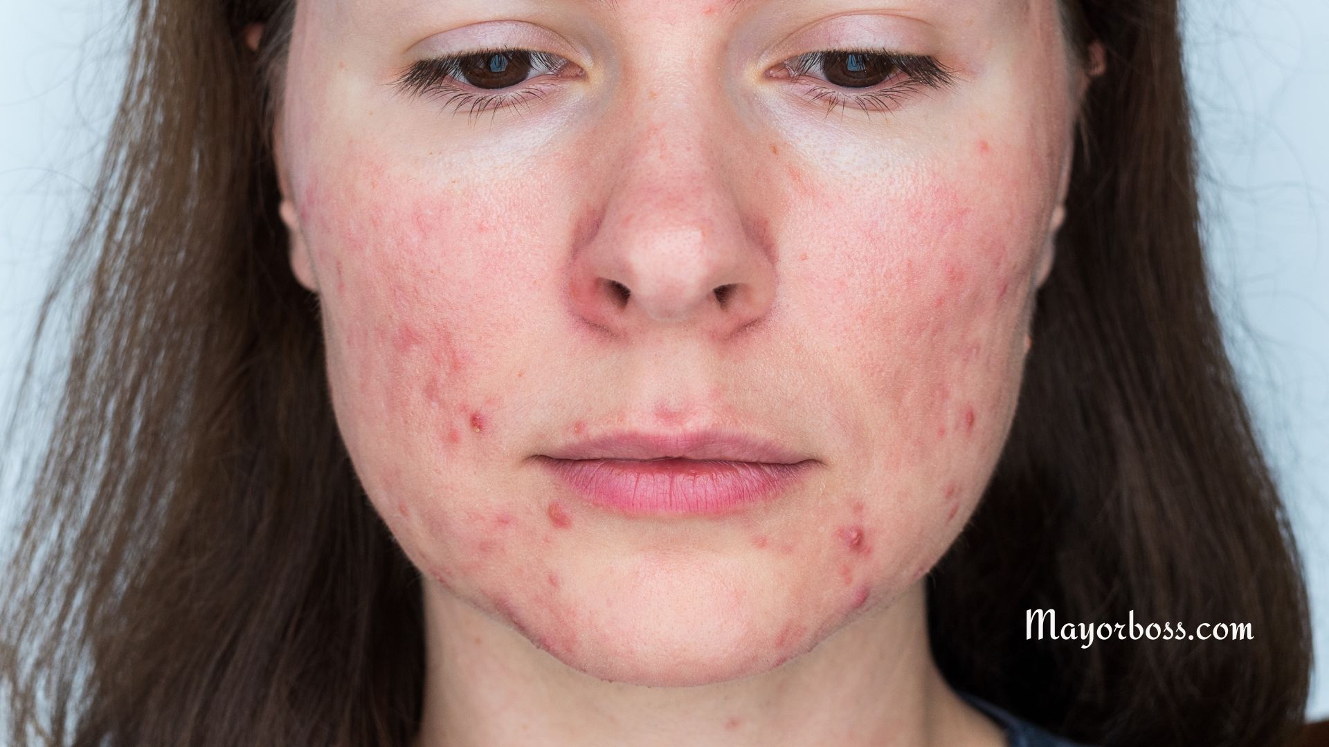 What Causes Rosacea?