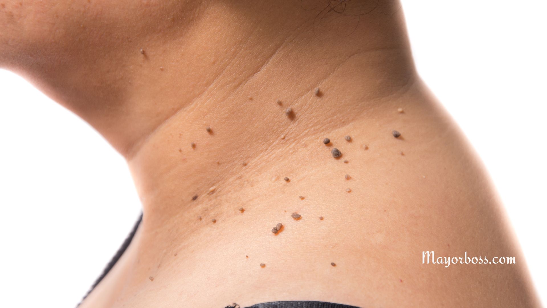 How to Get Rid of Skin Tags