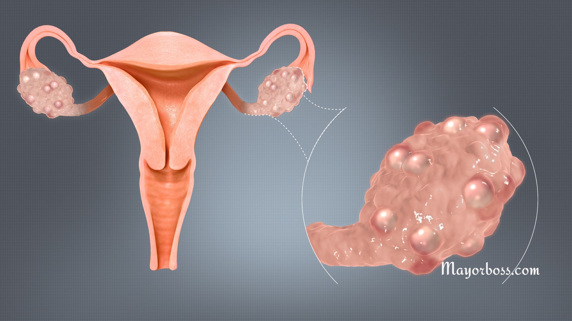 Polycystic Ovary Syndrome (PCOS)