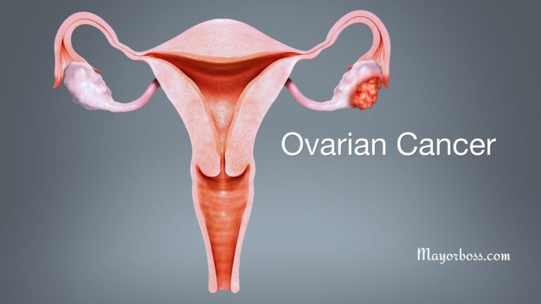 The Subtle Signs Of Ovarian Cancer