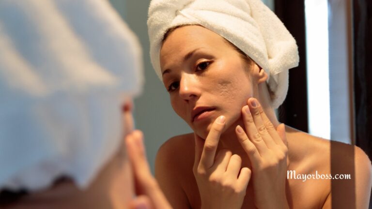 Acne in Adults