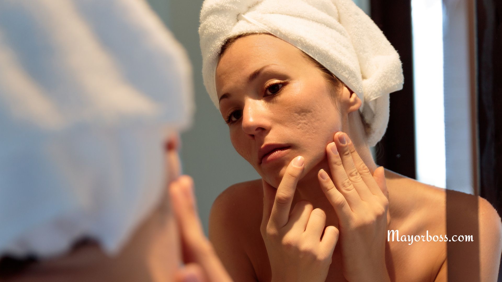 Acne in Adults