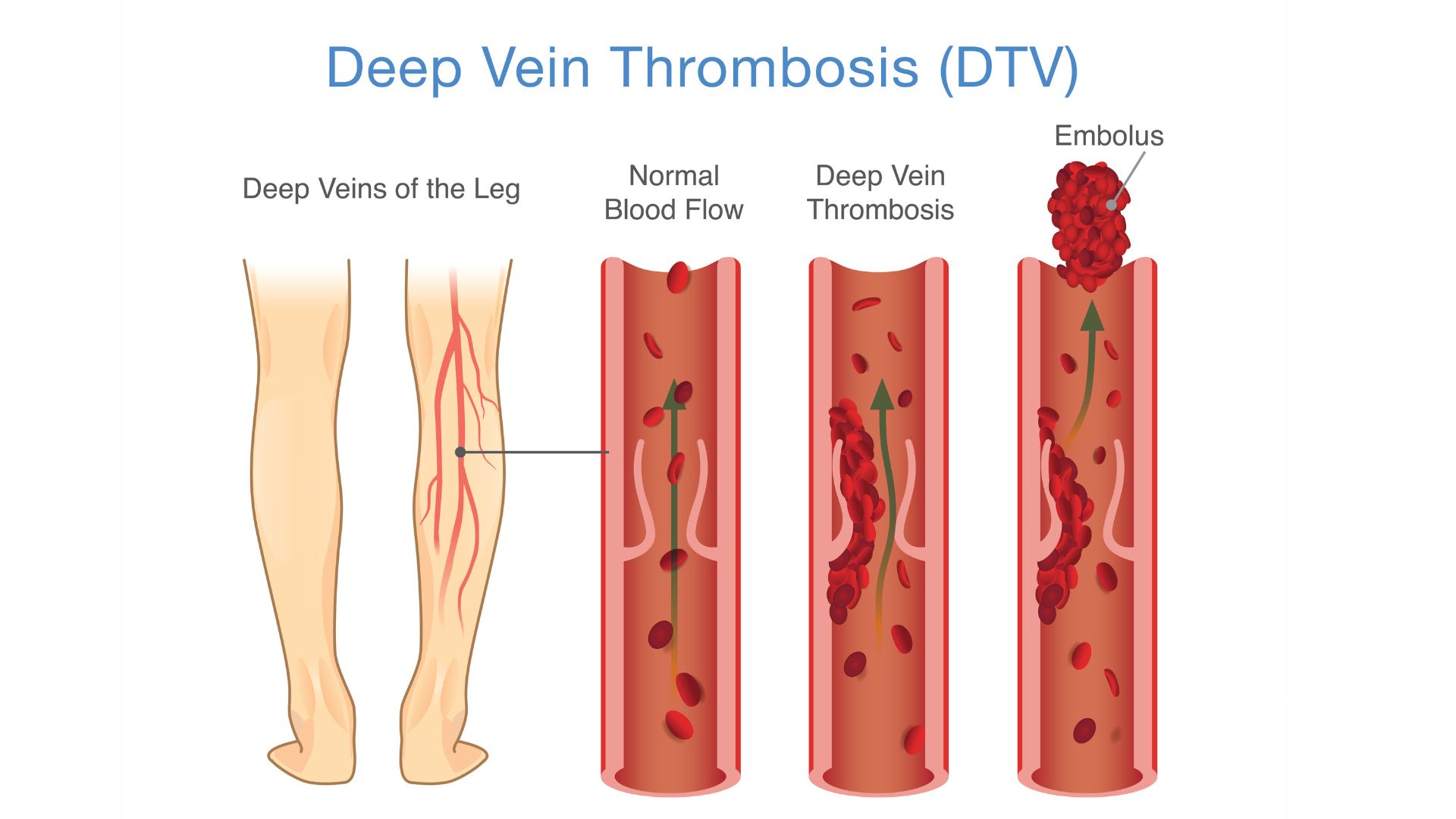 Blood Clots (in the Leg)