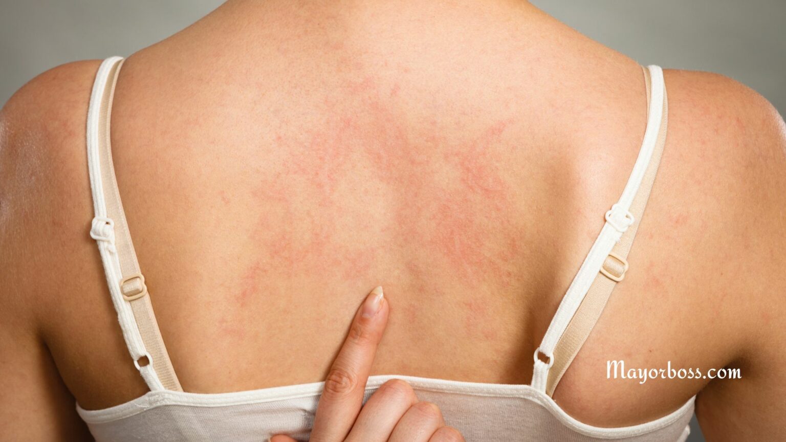 Hives Symptoms How to Tell if You Have Hives
