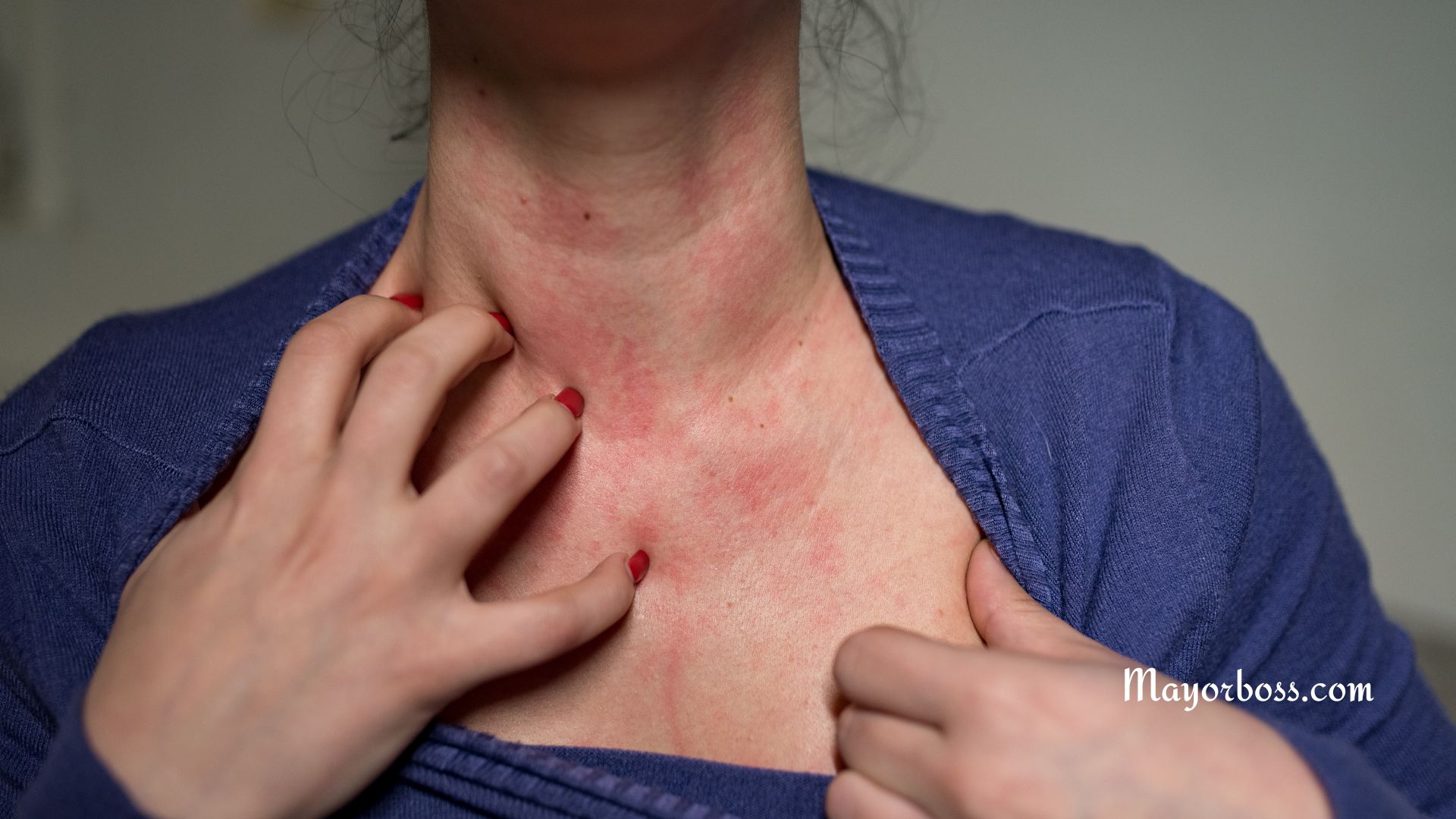 Hives Symptoms: What They Look Like