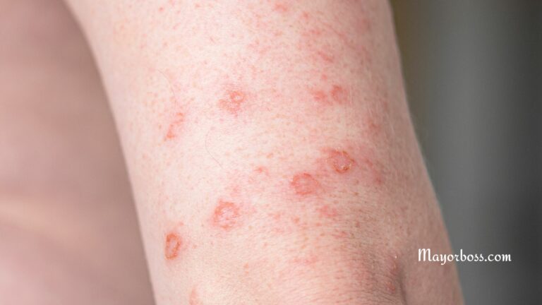 How Do You Get Syphilis