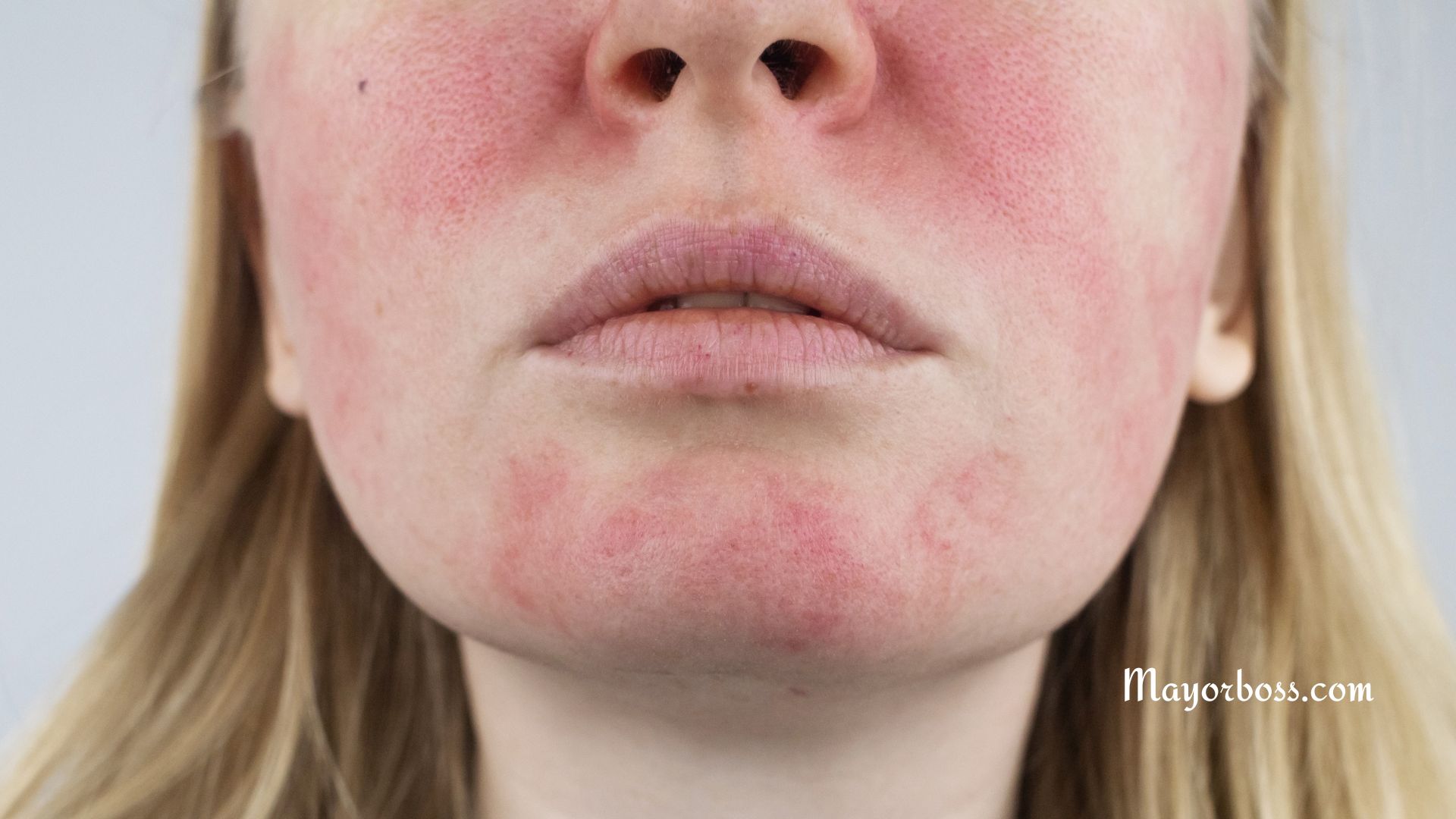 Are You Suffering From Rosacea? Here are 6 Triggers That Can Cause Rosacea Flare-Ups