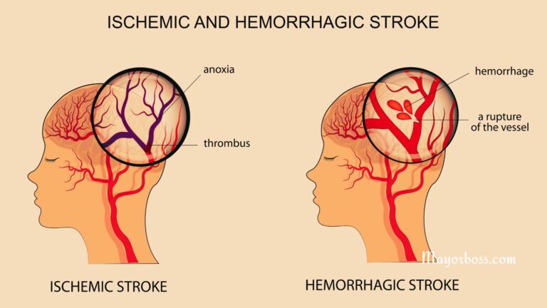 Stroke
