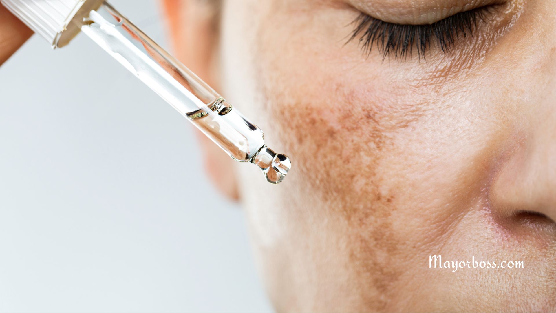 Ways to Treat Melasma