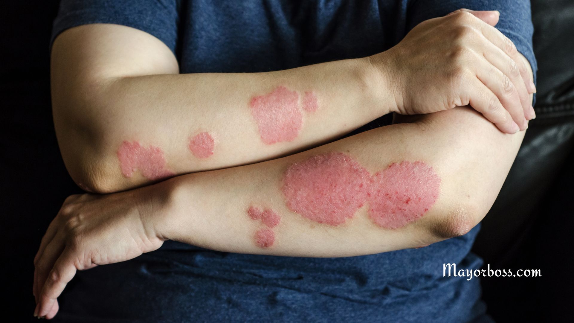 What Is Eczema?