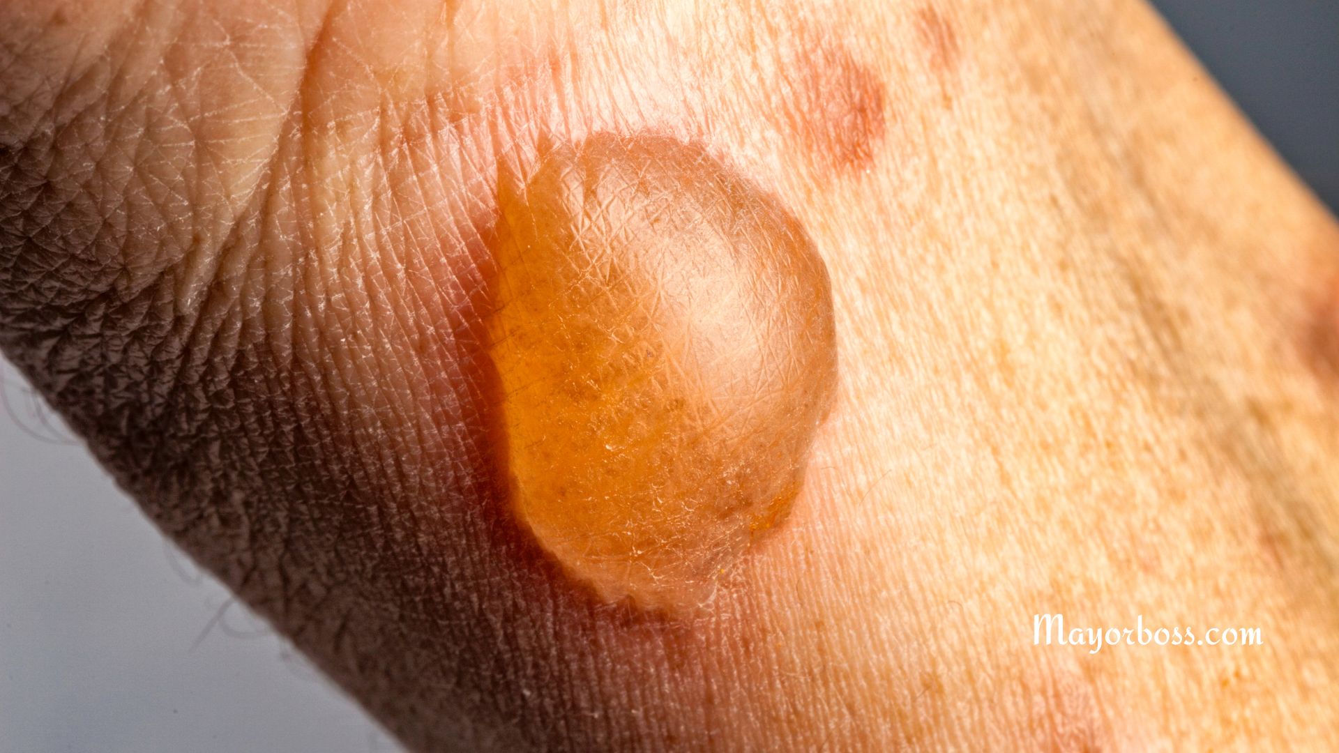 Blisters: What Are They and How to Treat Them