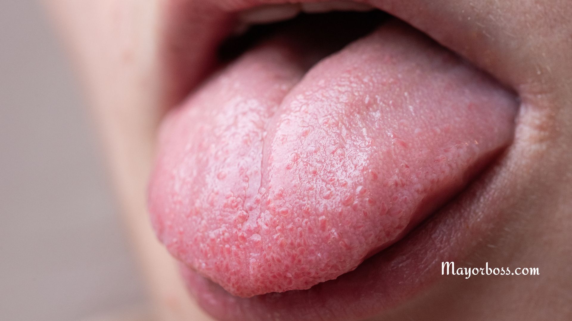 Bumps on Tongue: Common Causes and What to Do