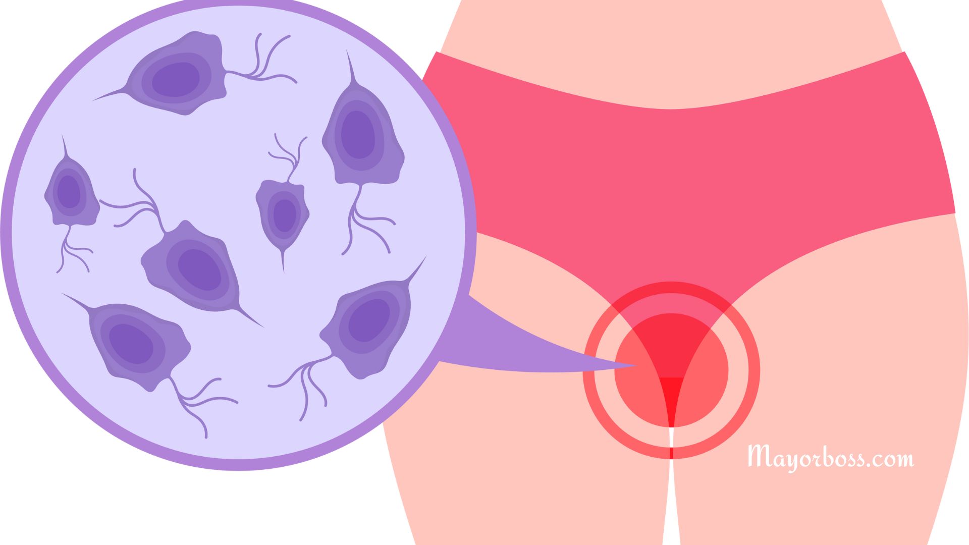Can a Yeast Infection Cause Bleeding