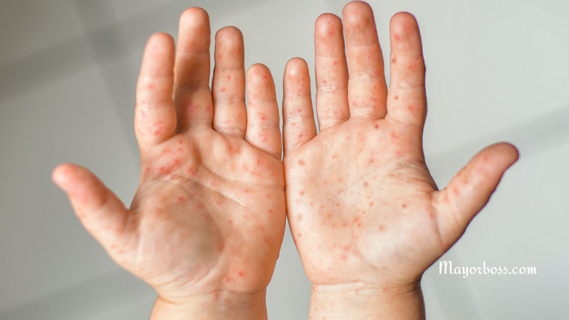 Hand, Foot, and Mouth Disease