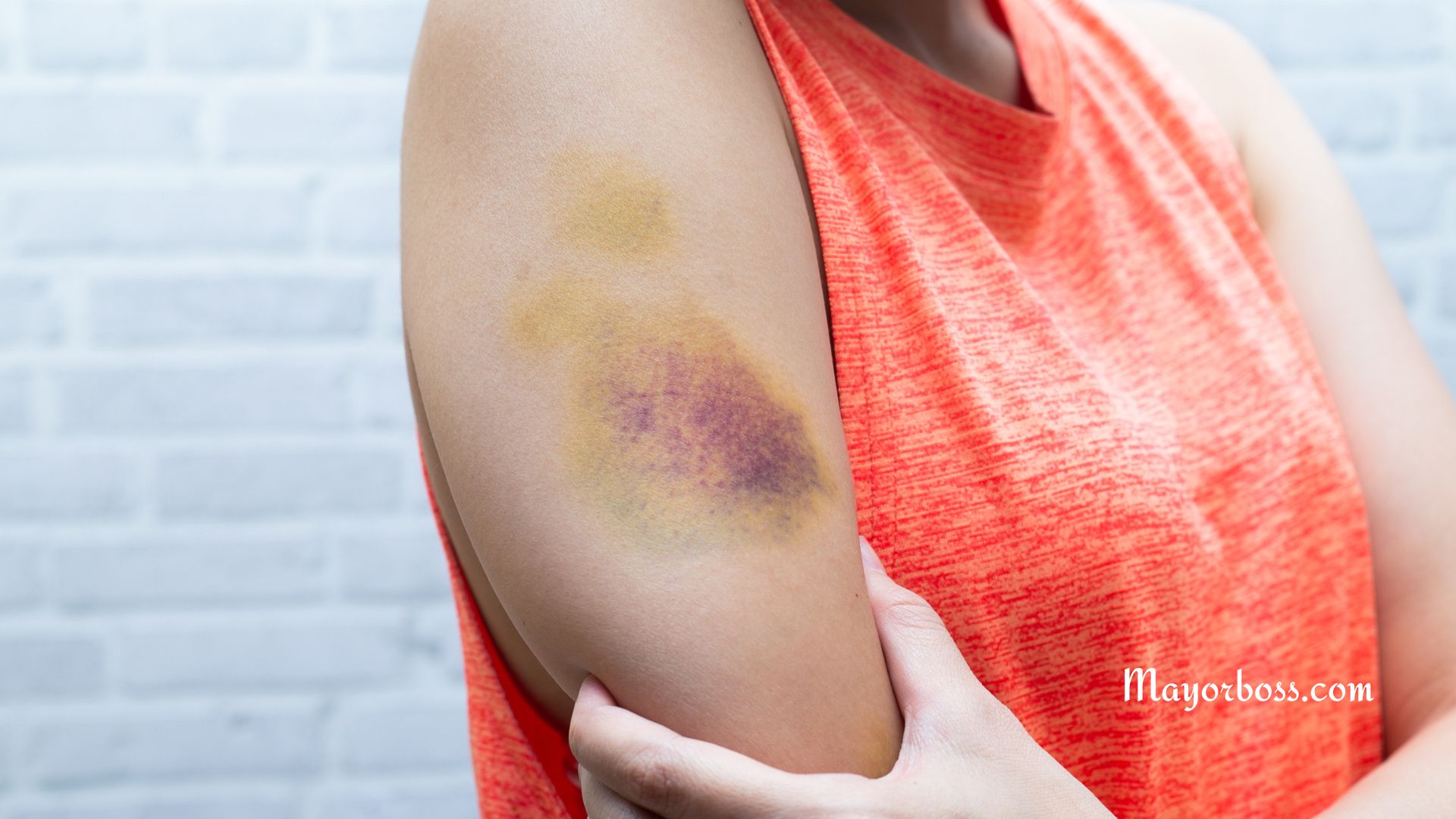 Here's Why Some People Bruise So Easily