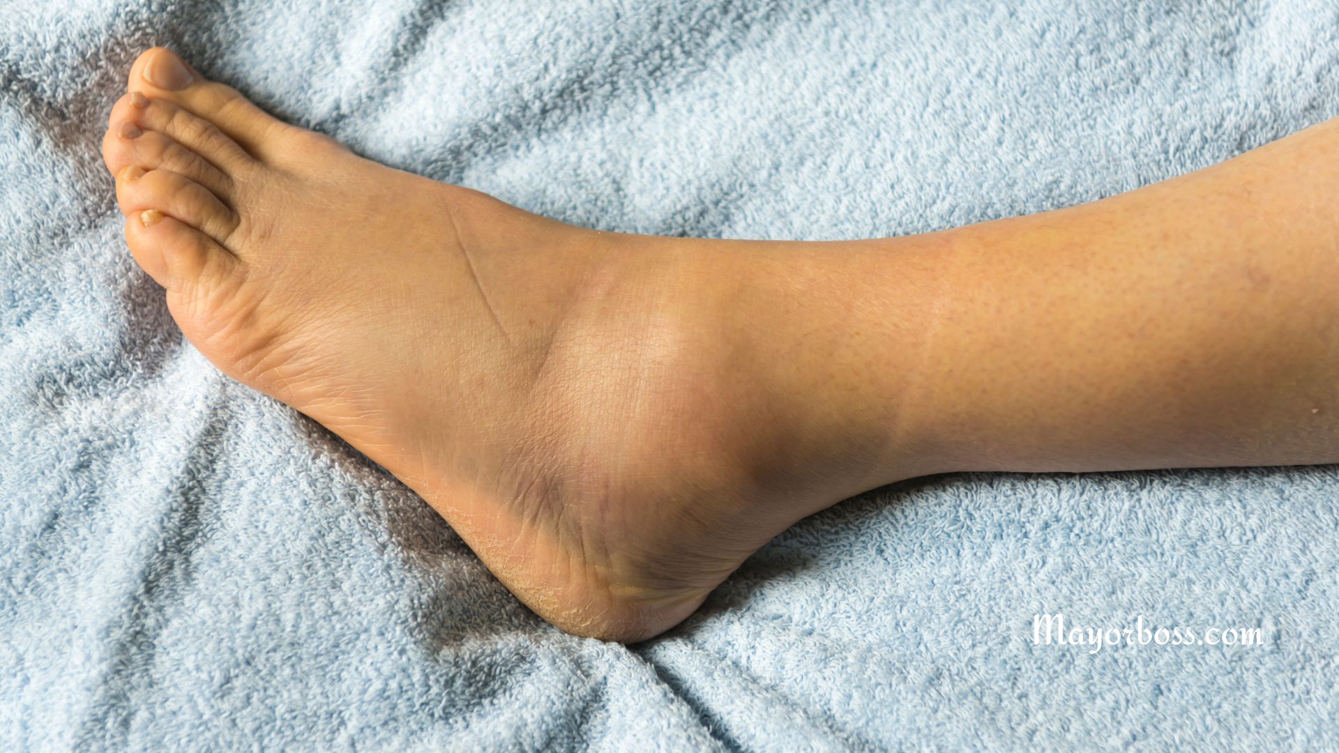 7 Home Remedies for Swollen Ankles