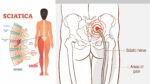 How to Ease Sciatic Nerve Pain