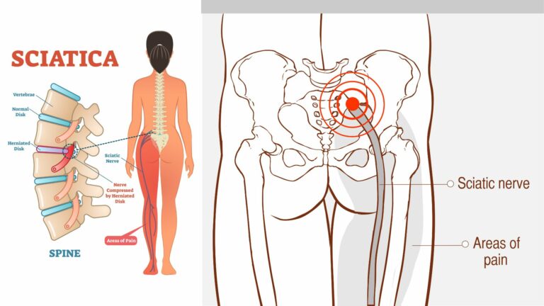 How to Ease Sciatic Nerve Pain