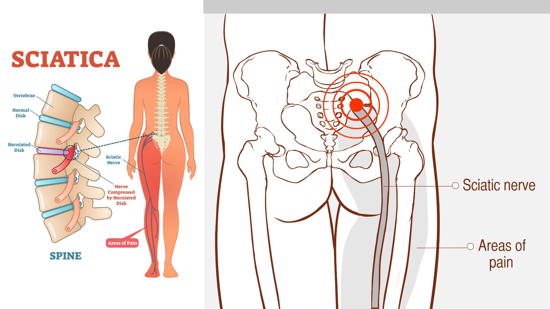 How to Ease Sciatic Nerve Pain