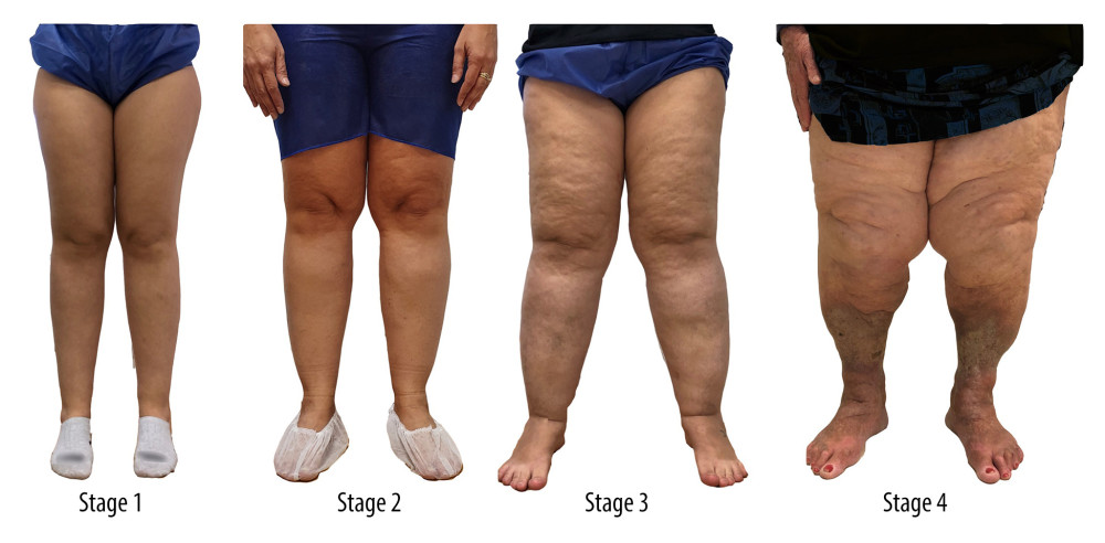 Lipedema