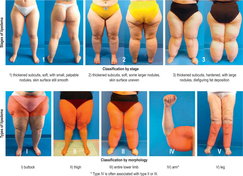 Lipedema: What Is It, and How Is It Treated?