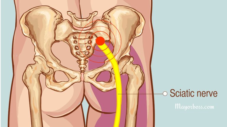 Sciatica