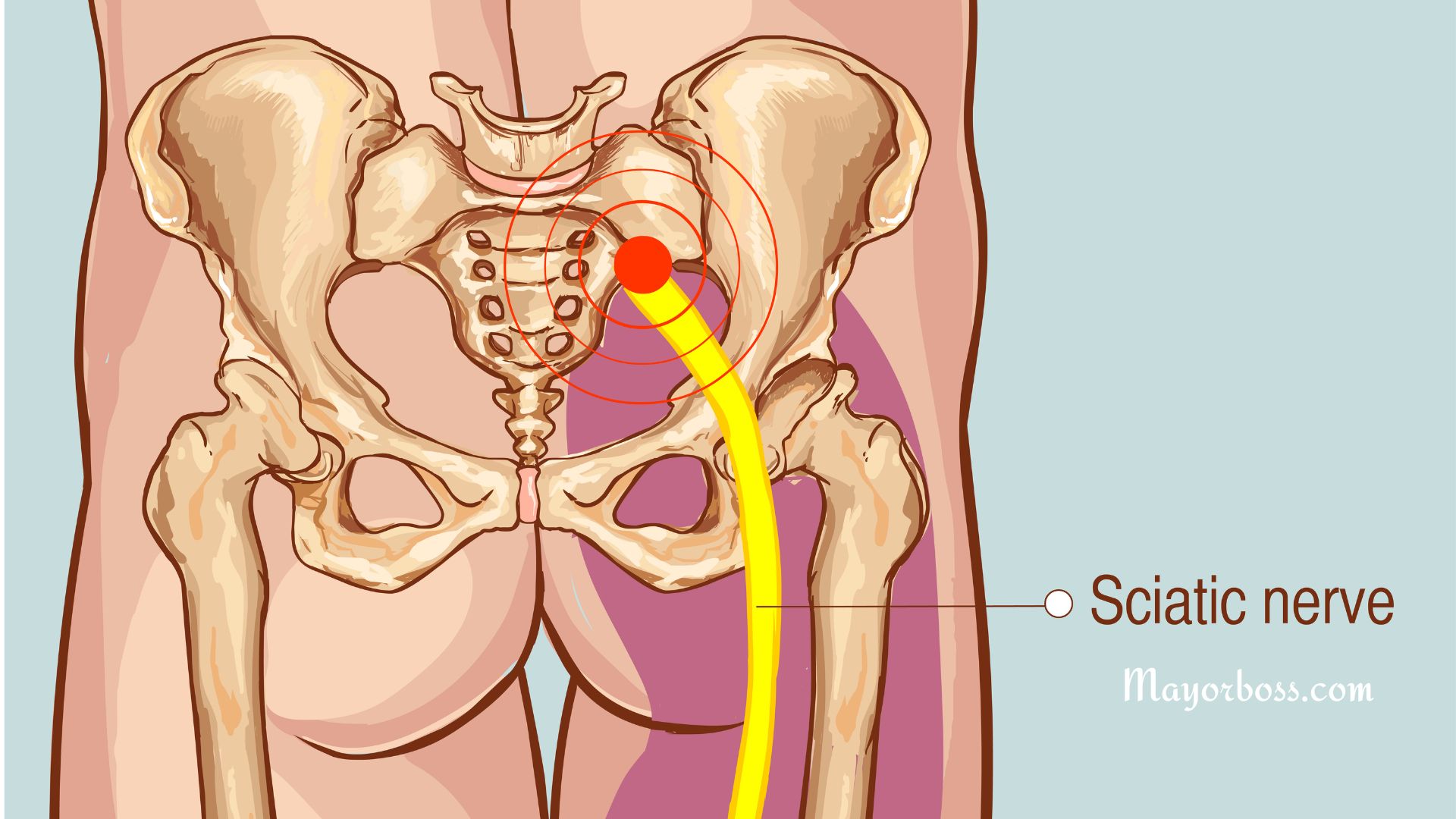 Sciatica: Why and How to Treat It