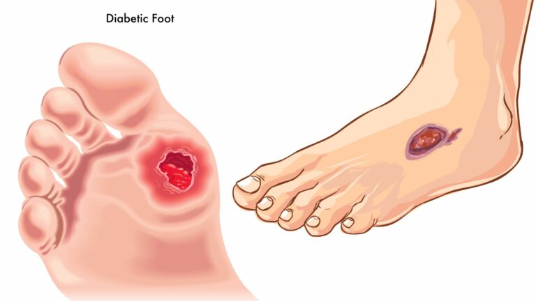 Signs That People with Diabetes Often Ignore