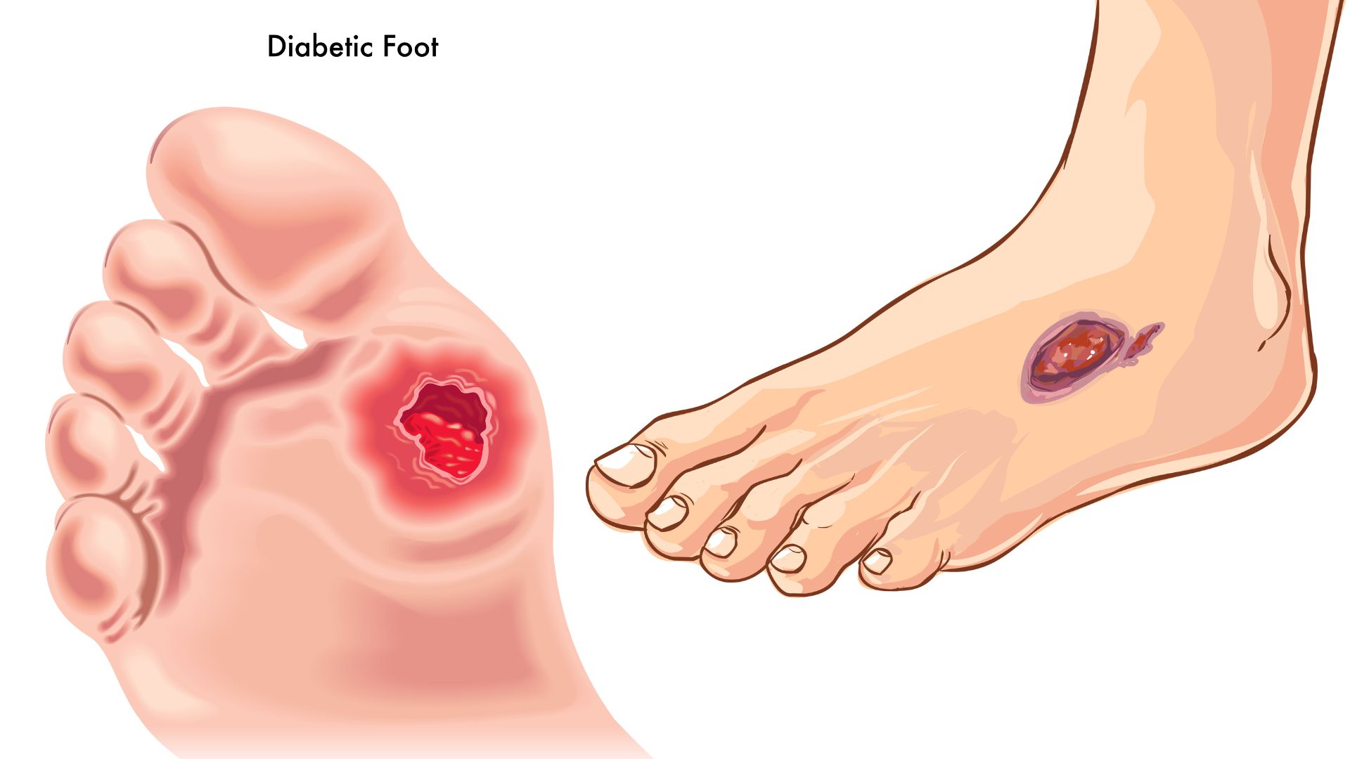 Signs That People with Diabetes Often Ignore