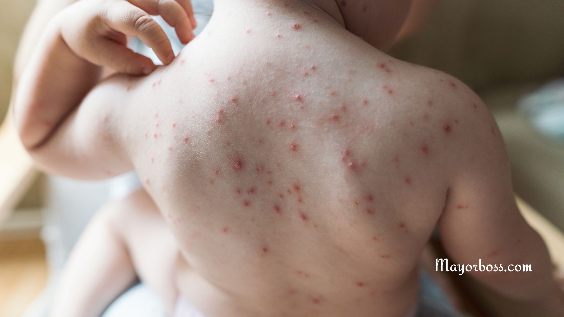 Things You Need to Know About Chickenpox