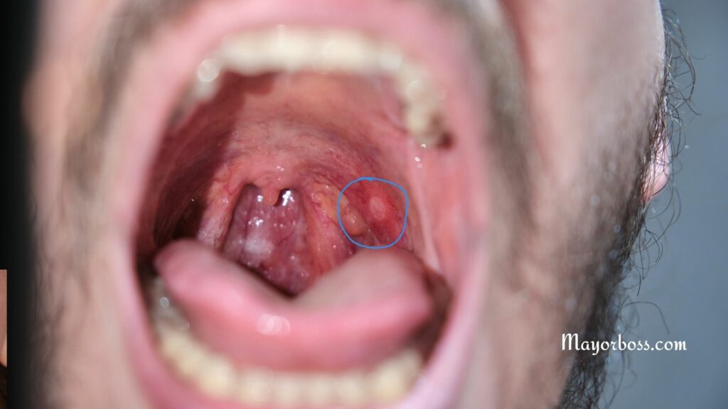 Throat Ulcers