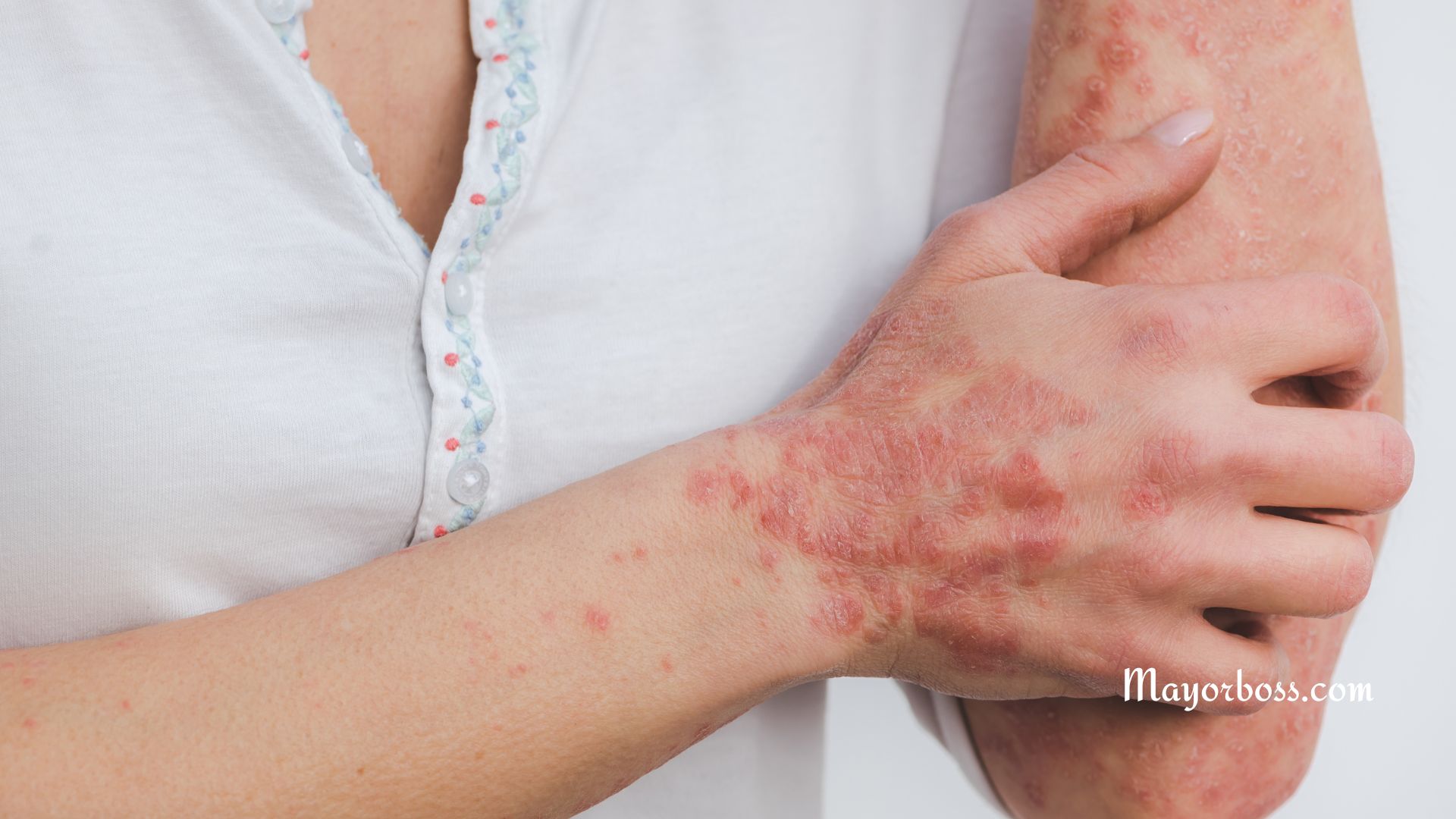 What Are Scabies and How Do You Get Them?