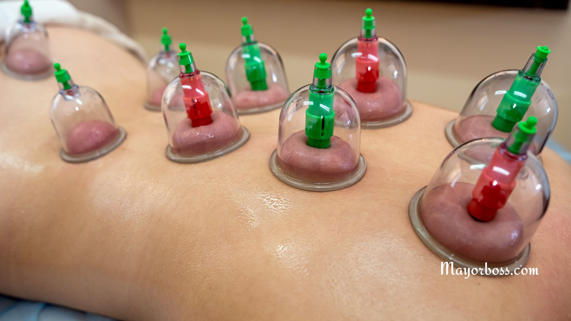 What Is Cupping Therapy? Benefits, Uses, and Side Effects