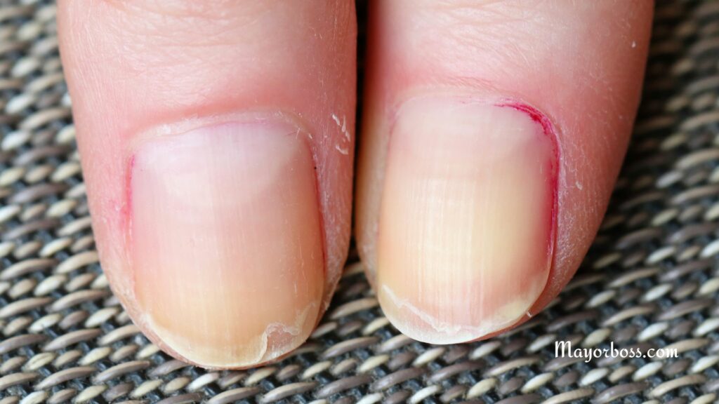 Cracked or Split Nails
