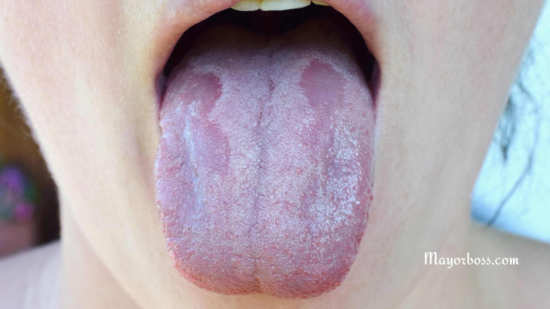 What is Oral Thrush