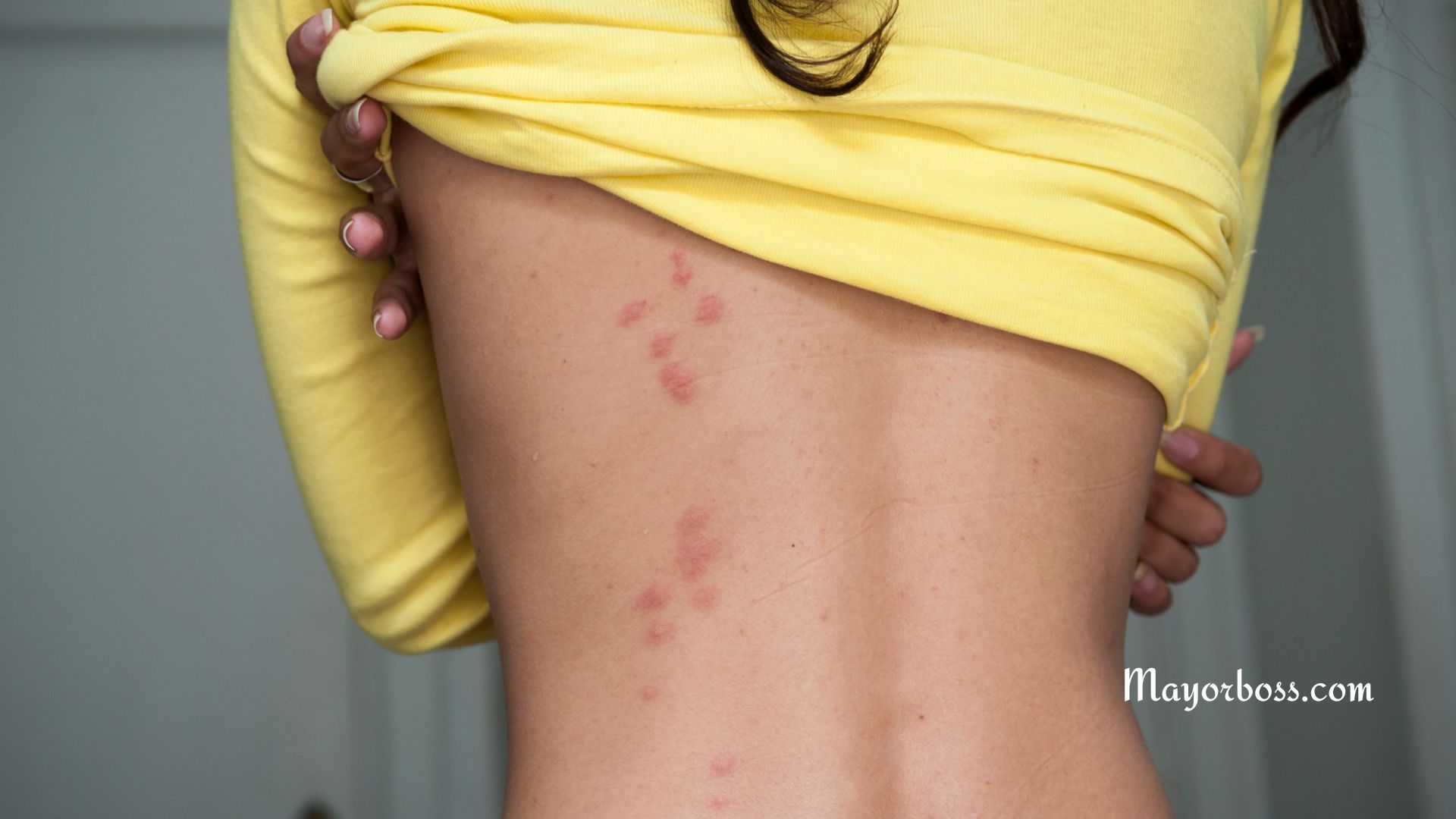 bed bugs is the itchy bites on your skin