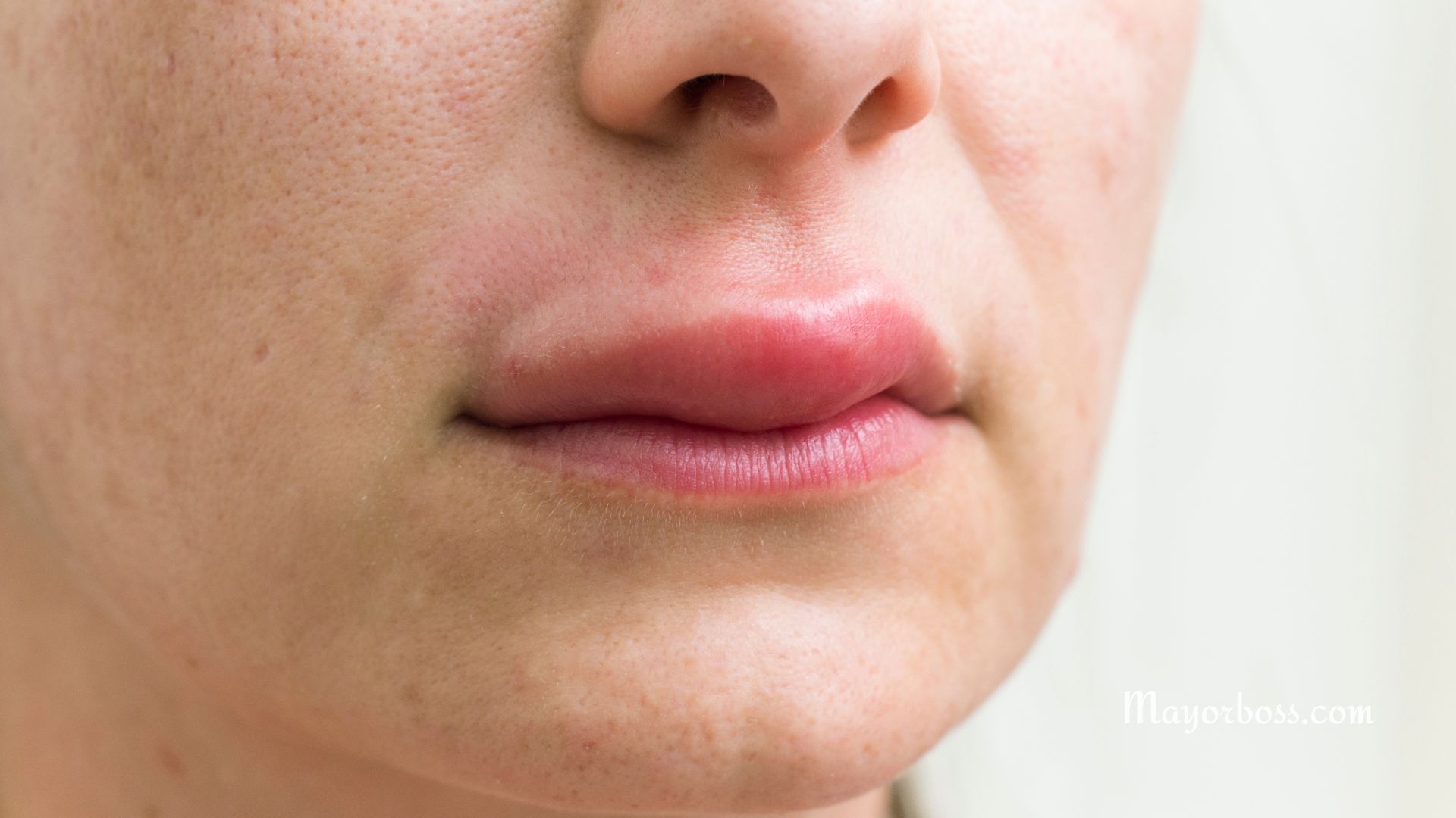 Allergic Reactions on the Lips