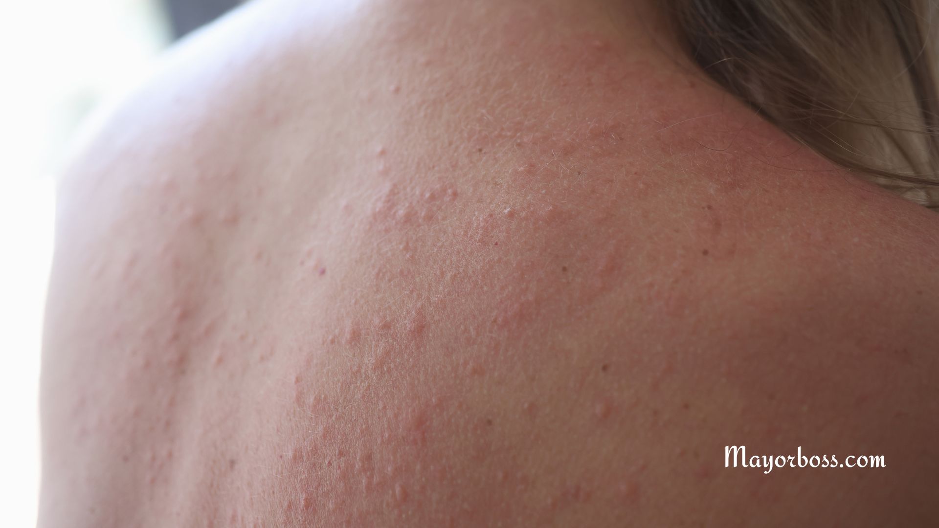 Can Stress Cause Rashes?