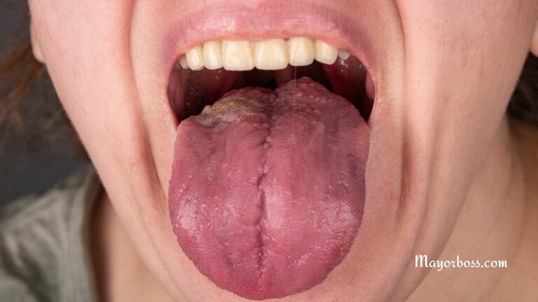 Chlamydia in the Throat