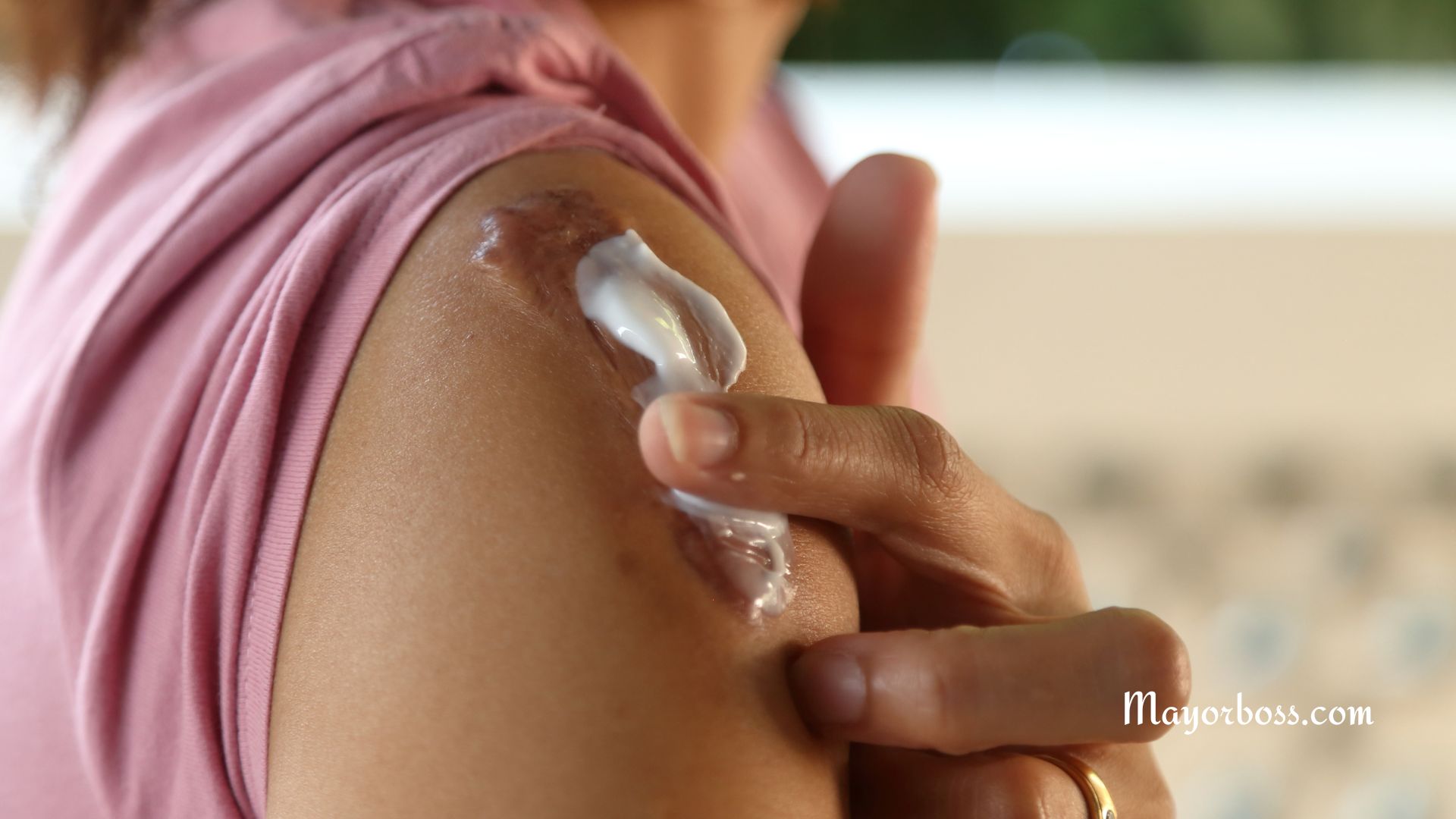 how to get rid of keloids